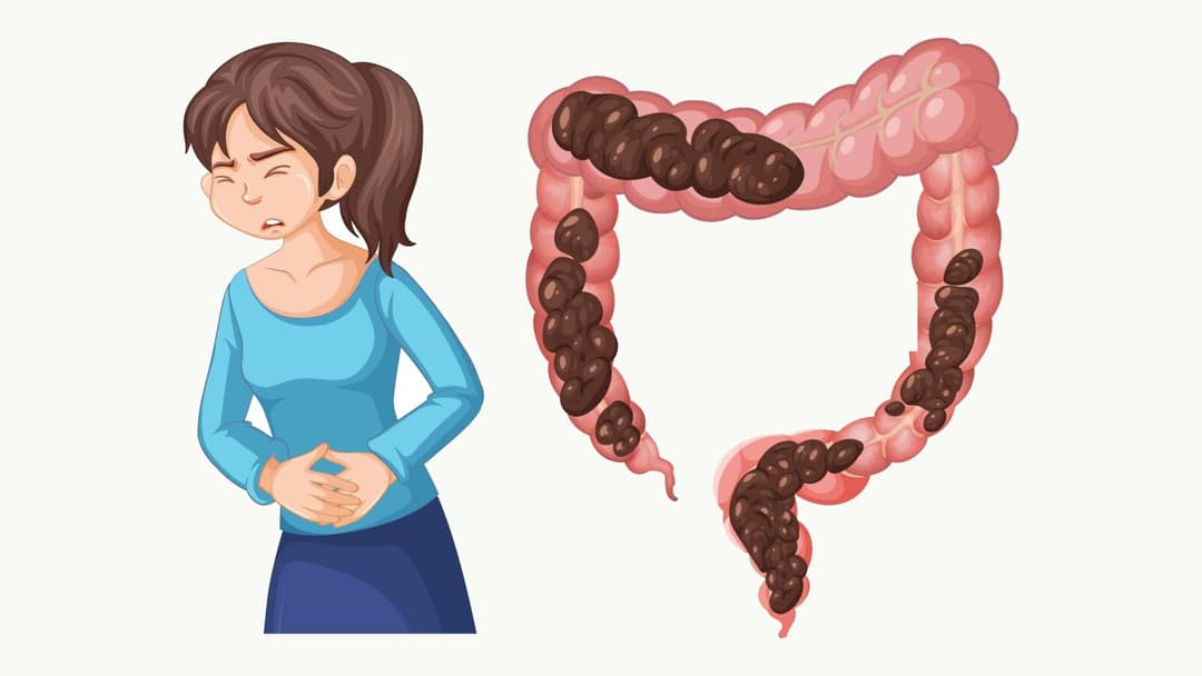 Ilustrație cu o femeie care își ține abdomenul din cauza disconfortului și un colon (intestinul gros) cu materii fecale întărite, vizual pentru articolul despre constipație: cauze, simptome de alarmă și reglarea tranzitului intestinal.