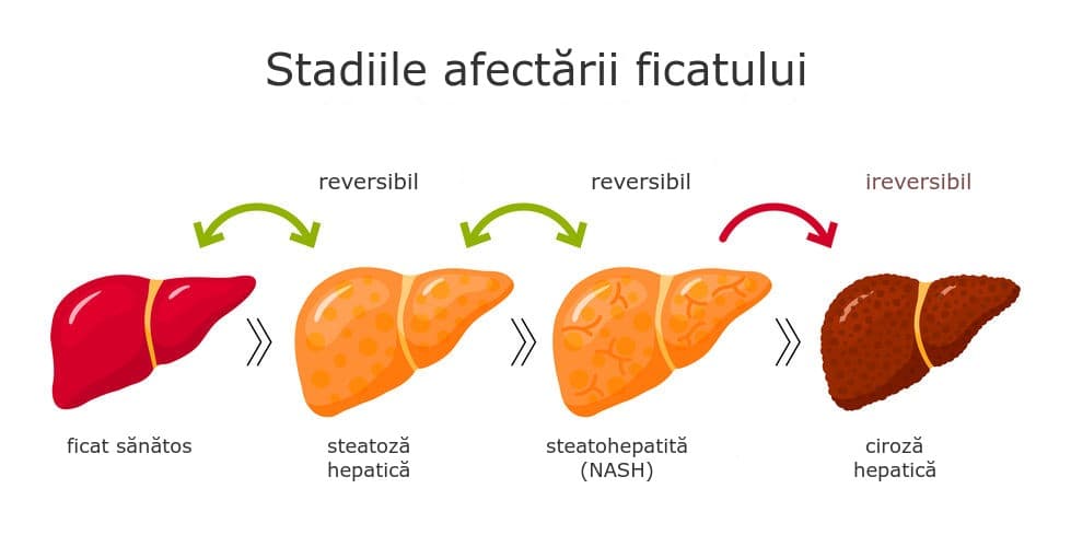 Stadiile afectării ficatului în steatoza hepatică: ficat sănătos, ficat gras (steatoză), steatohepatită cu inflamație și ciroză.