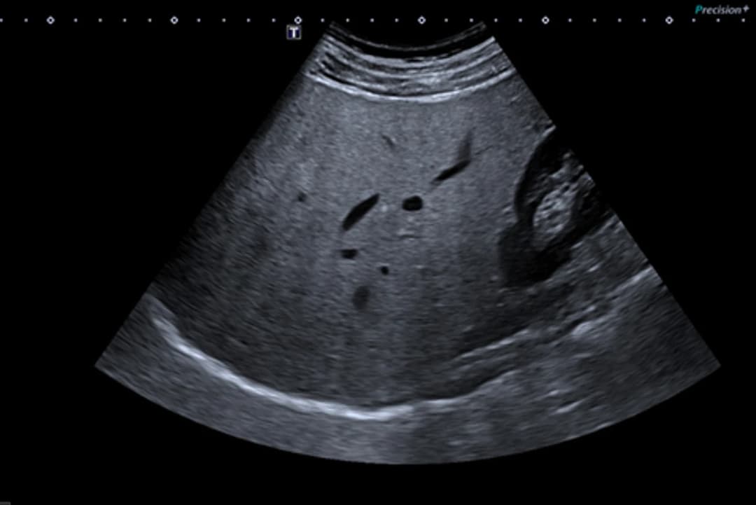 Imagine de ecografie abdominală a ficatului, investigația prin care se descoperă și se monitorizează steatoza hepatică (ficatul gras), în cabinetul Dr. Gabriela Negrean din Zalău.