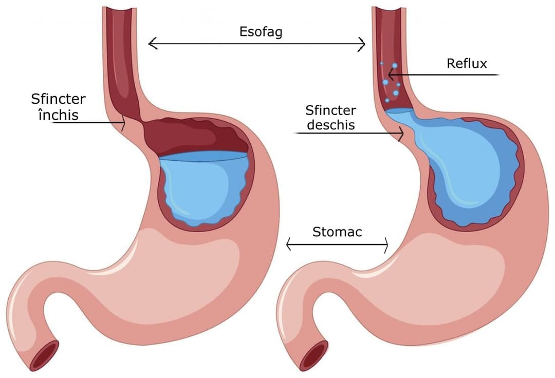 Diagramă a refluxului gastroesofagian: în stânga, sfincterul esofagian inferior închis; în dreapta, sfincterul deschis lasă conținutul acid din stomac să urce în esofag, mecanismul care produce esofagita de reflux.